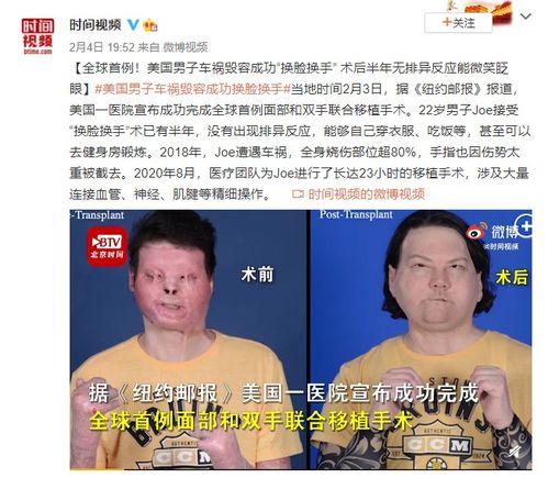 全球首例同时换脸换手男子结婚，跨越障碍，共筑幸福人生